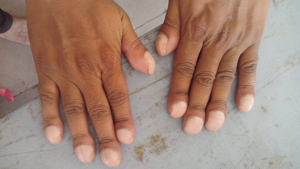 Hepatopulmonale Hypertonie