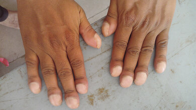 Hepatopulmonale Hypertonie