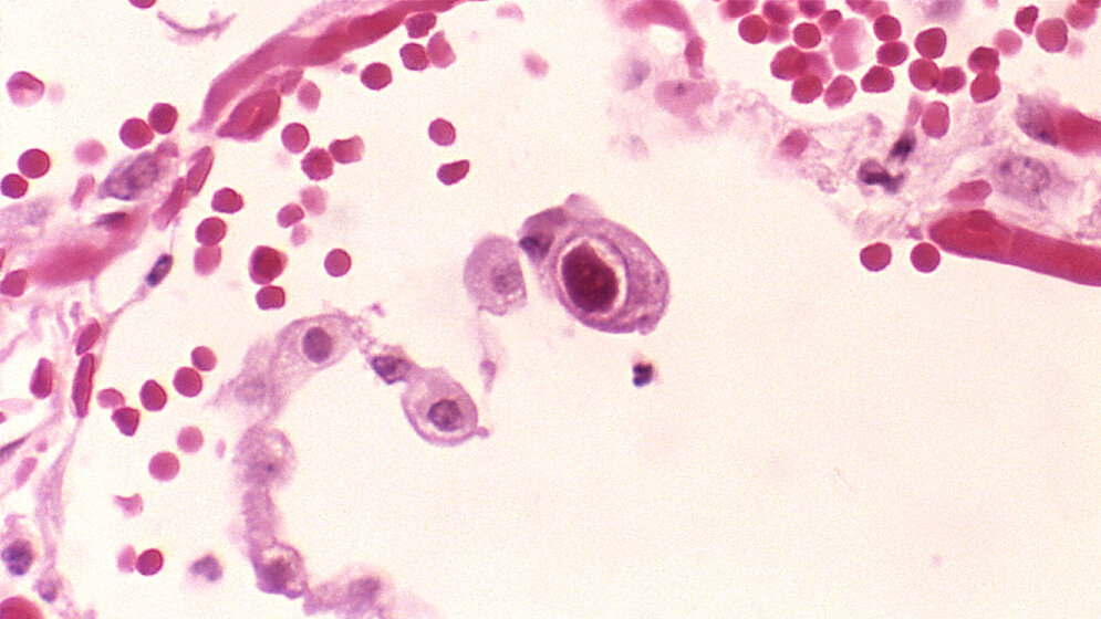 Cytomegalovirus_CDC_Dr_Edwin_P_Ewing_Jr_gemeinfrei_28062016.jpg Cytomegalievirus