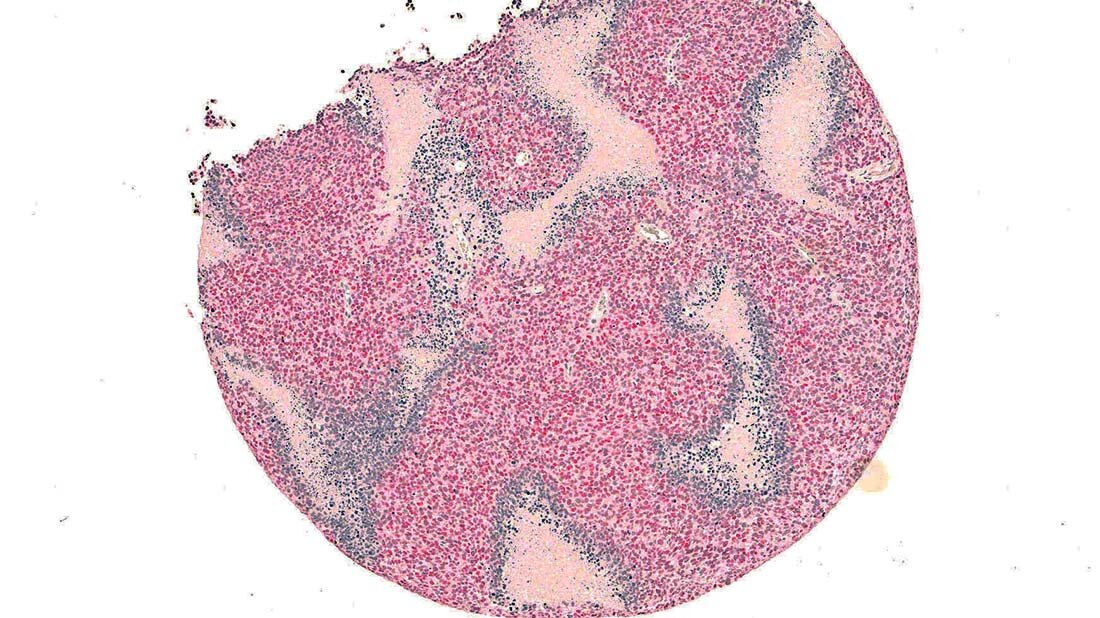 Gewebeschnitt durch ein Ewing-Sarkom
