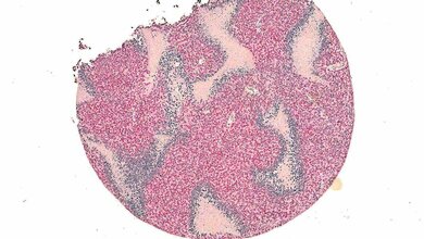 Gewebeschnitt durch ein Ewing-Sarkom