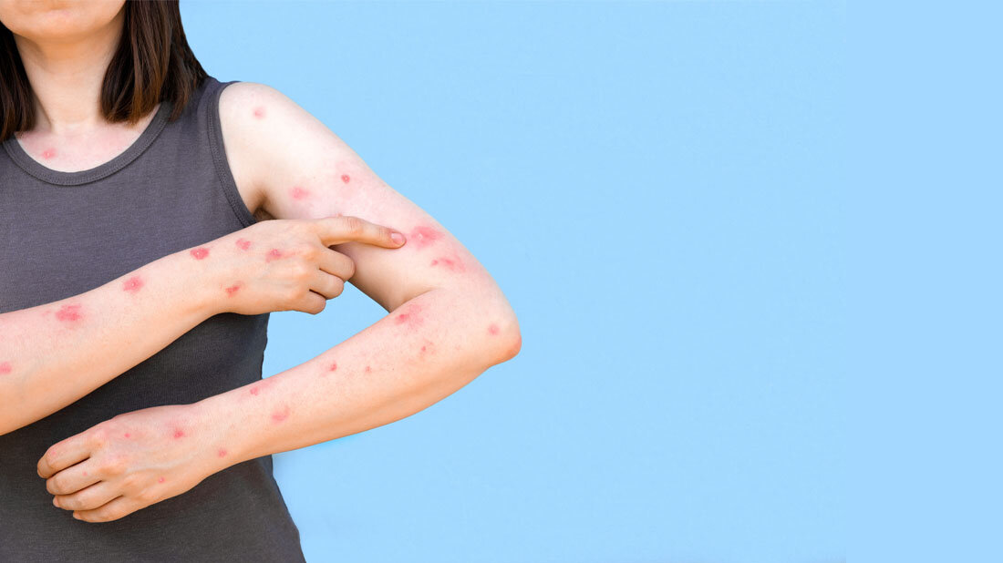 Frau mit Affenpocken, neu mpox genannt