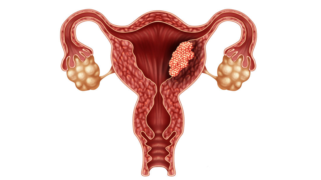 Schaubild für Endometriumkarzinom.