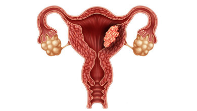 Schaubild für Endometriumkarzinom.