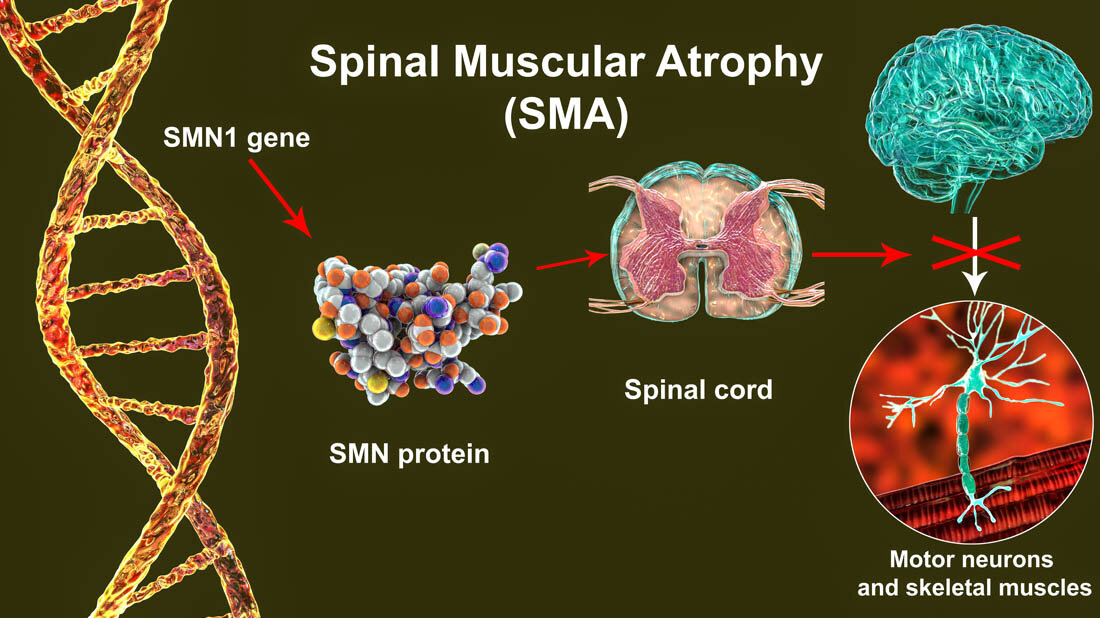 Ursache von SMA (schematische Darstellung).