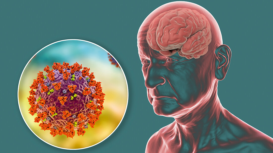 Führt die Infektion mit SARS-CoV-2 zu Alzheimer? Titelbild des Fachbeitrags zur Frage, ob die Infektion mit SARS-CoV-2 zu einer Alzheimer-Erkrankung führen kann