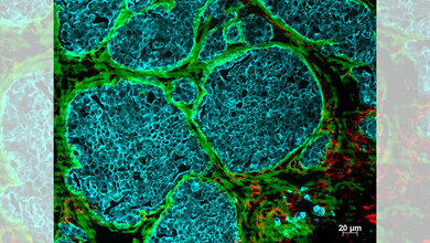 Gewebeschnitt eines Brusttumors einer Maus