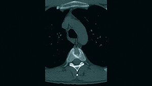 Skelettale Veränderungen 3.5: Schmetterlingswirbel