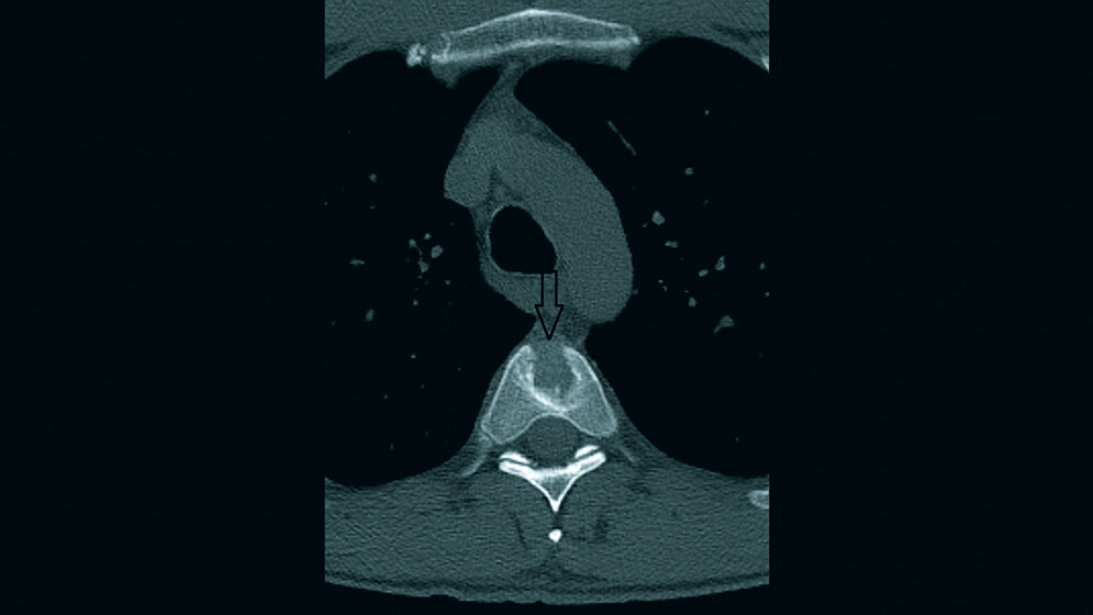 Skelettale Veränderungen 3.5: Schmetterlingswirbel