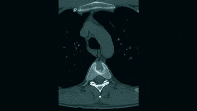 Skelettale Veränderungen 3.5: Schmetterlingswirbel