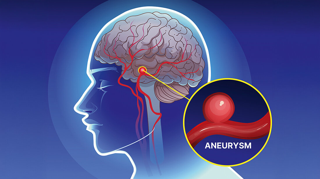 Grafische Darstellung eines zerebralen Aneurysmas