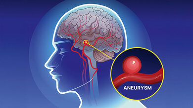 Grafische Darstellung eines zerebralen Aneurysmas
