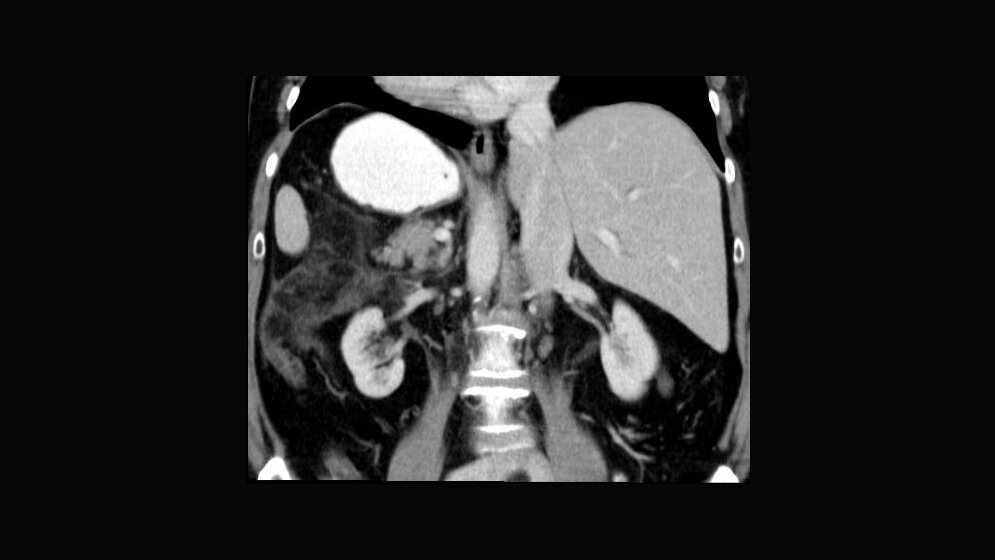 Anomalien und Normvarianten – Interne Veränderungen 2.10: Situs inversus (totalis)