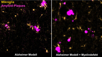 Alzheimer_Myelin.jpg Mikroglia beseitigen eigentlich Amyloid-Plaques