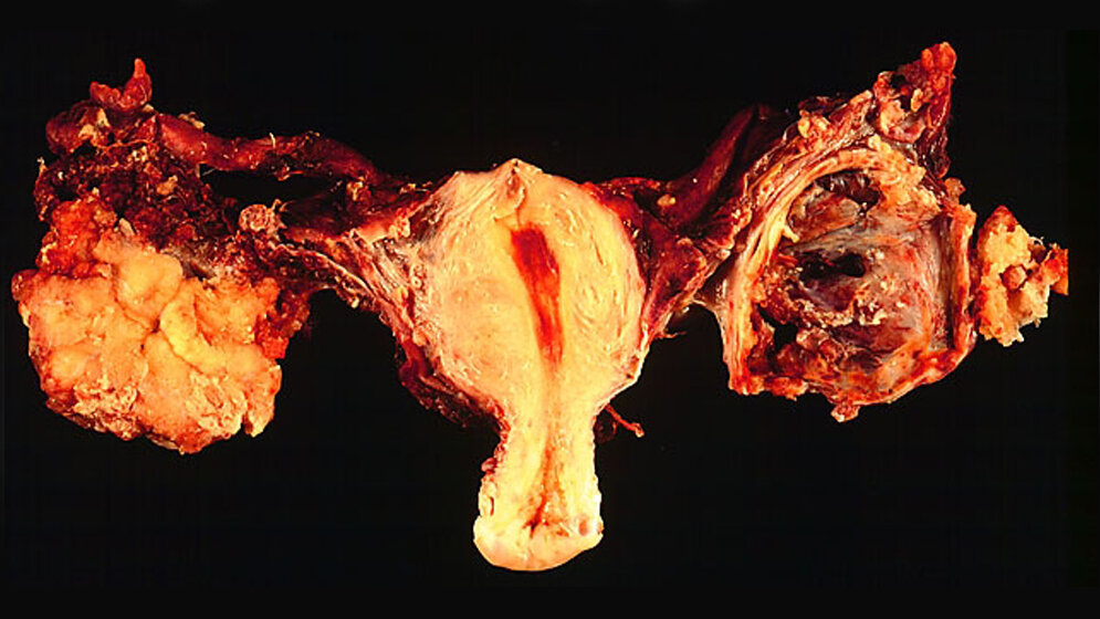 Beidseitiges Ovarialkarzinom