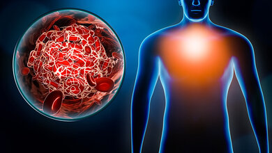 Darstellung eines menschlichen Körpers mit hervorgehobenem Brustbereich und einer Nahaufnahme eines Blutgerinnsels, symbolisiert Herz-Kreislauf-Erkrankungen.