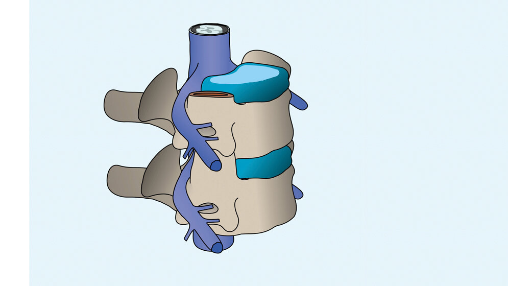 Titelbild_ACDF_oblique_blank.jpg Nucleus pulposus