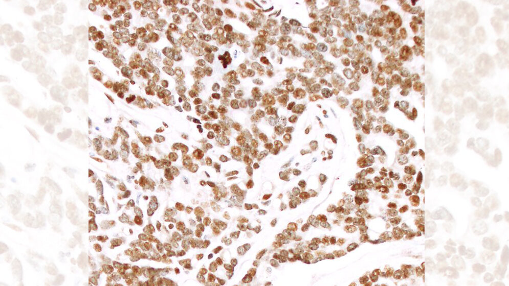 metastasiertes und schnell wachsendes Prostatakarzinom 