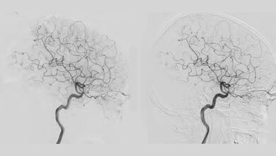 Technologien zur Dosisreduktion in der interventionellen Radiologie Strahlenschutz