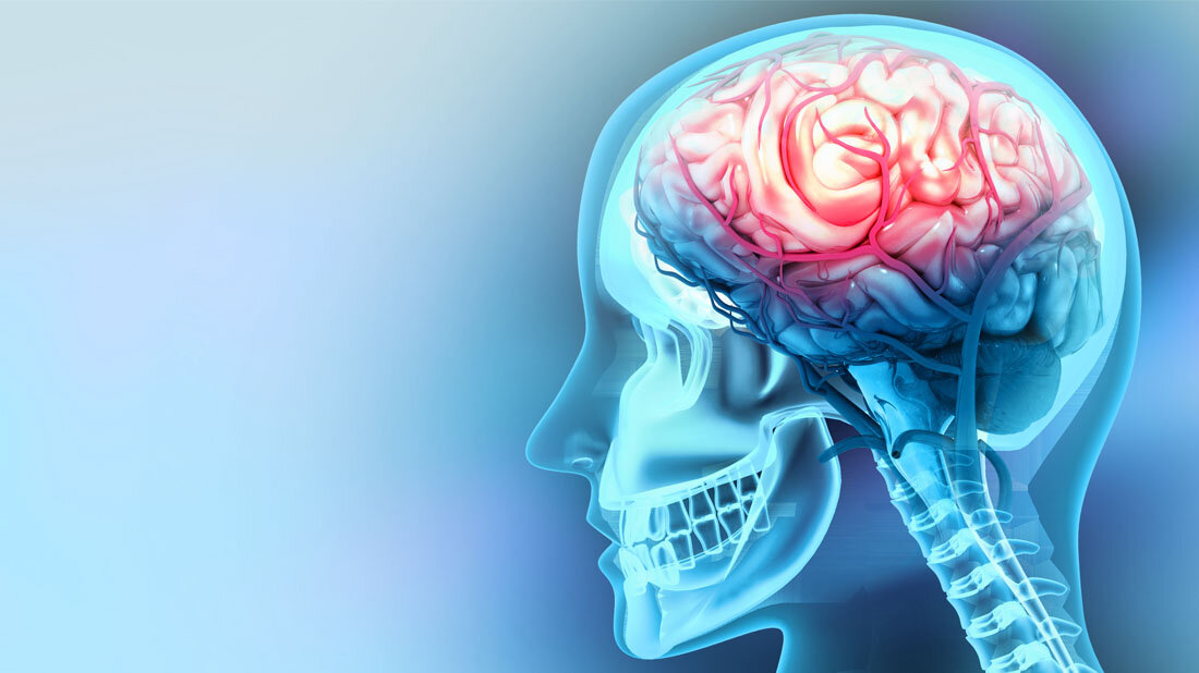 Hirnblutungen besser erkennen