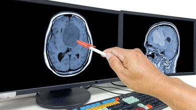 Hirntumor_Radiologie.jpg Glioblastome individualisiert bekämpfen