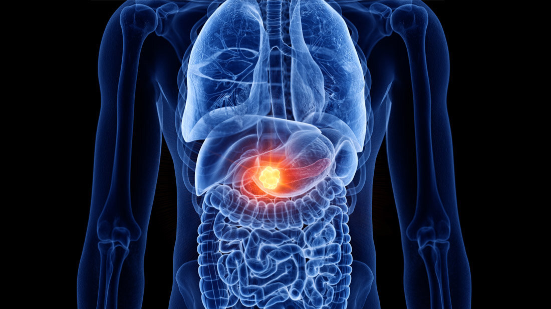 Pankreaskarzinom_01.jpg Pankreaskarzinom