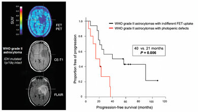 Patient mit niedriggradigem hirneigenen Tumor
