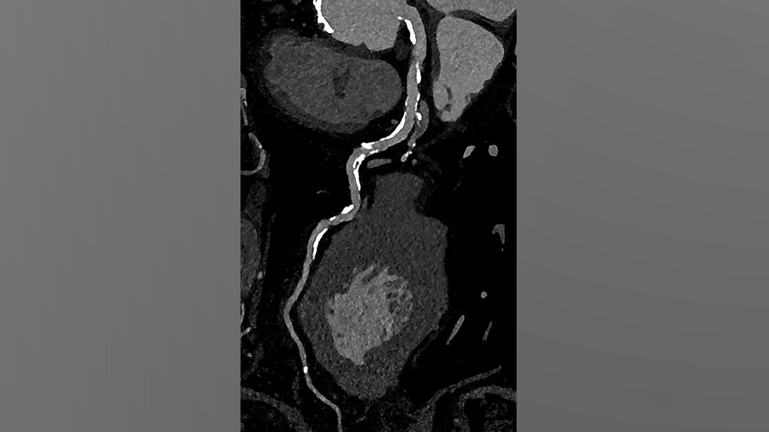 Photo_Counting_CT.jpg Photon-Counting-CTals Alternative zum Herzkatheter