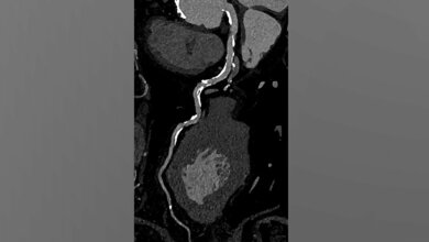 Photon-Counting-CTals Alternative zum Herzkatheter