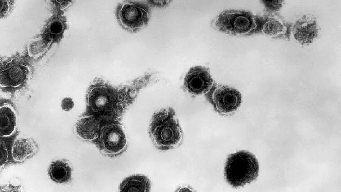 Varizella-Zoster-Virus (VZV) Virionen des Varizella-Zoster-Virus