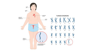 Schematische Darstellung der genetischen Besonderheiten beim Ullrich-Turner-Syndrom