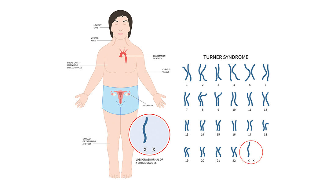 Schematische Darstellung der genetischen Besonderheiten beim Ullrich-Turner-Syndrom