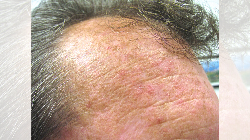 Aktinische Keratose