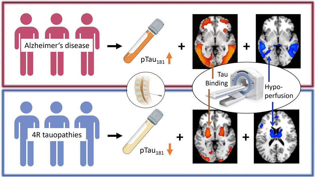 Sichere Unterscheidung von Alzheimer und primärer Tauopathie
