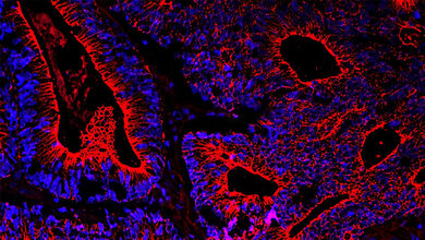 Darmkrebs unter dem Mikroskop
