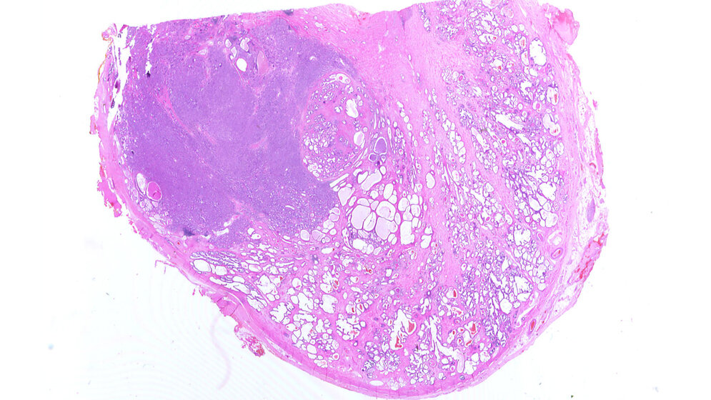 Prostata mit Adenokarzinom