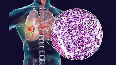 Small Cell Lung Cancer