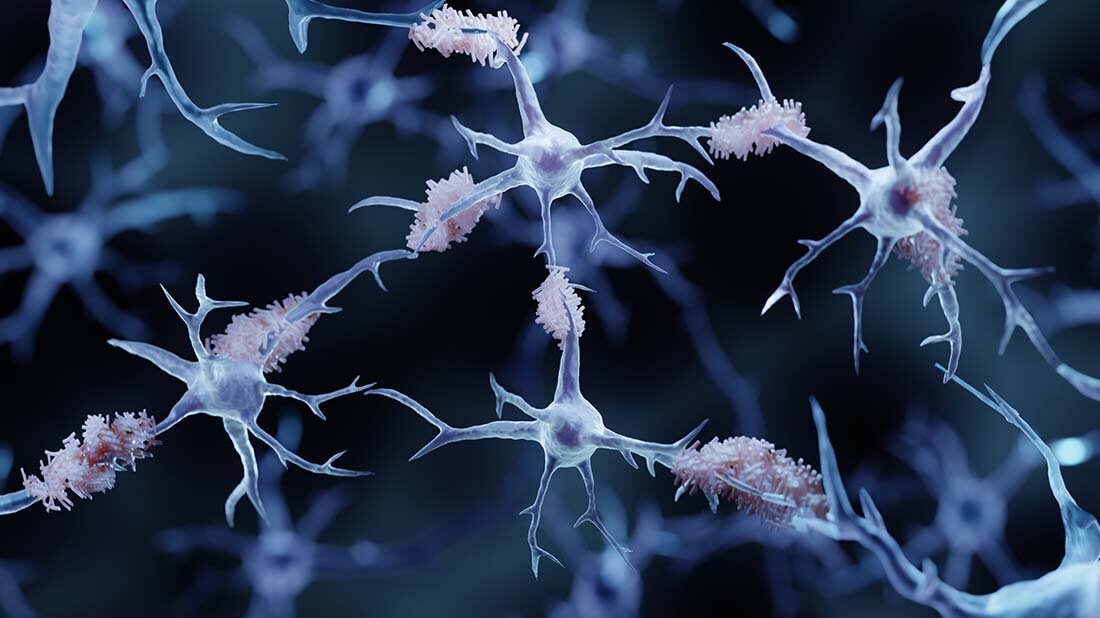 Alzheimerforschung immer effektiver