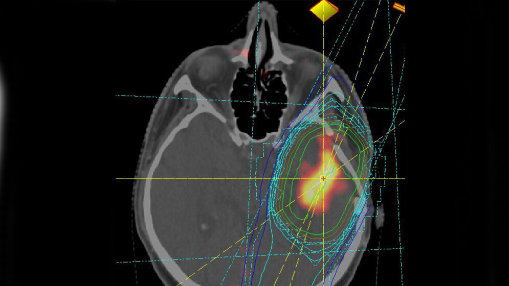 Bestrahlungsplan eines Glioblastoms