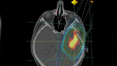 Bestrahlungsplan eines Glioblastoms