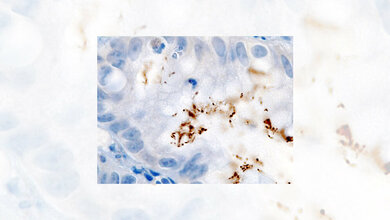 Helicobacter pylori Infektion