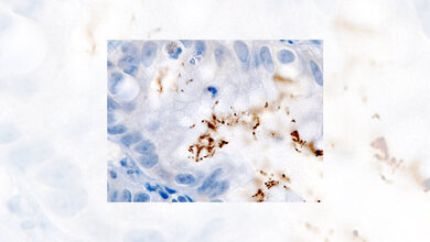 Helicobacter pylori Infektion