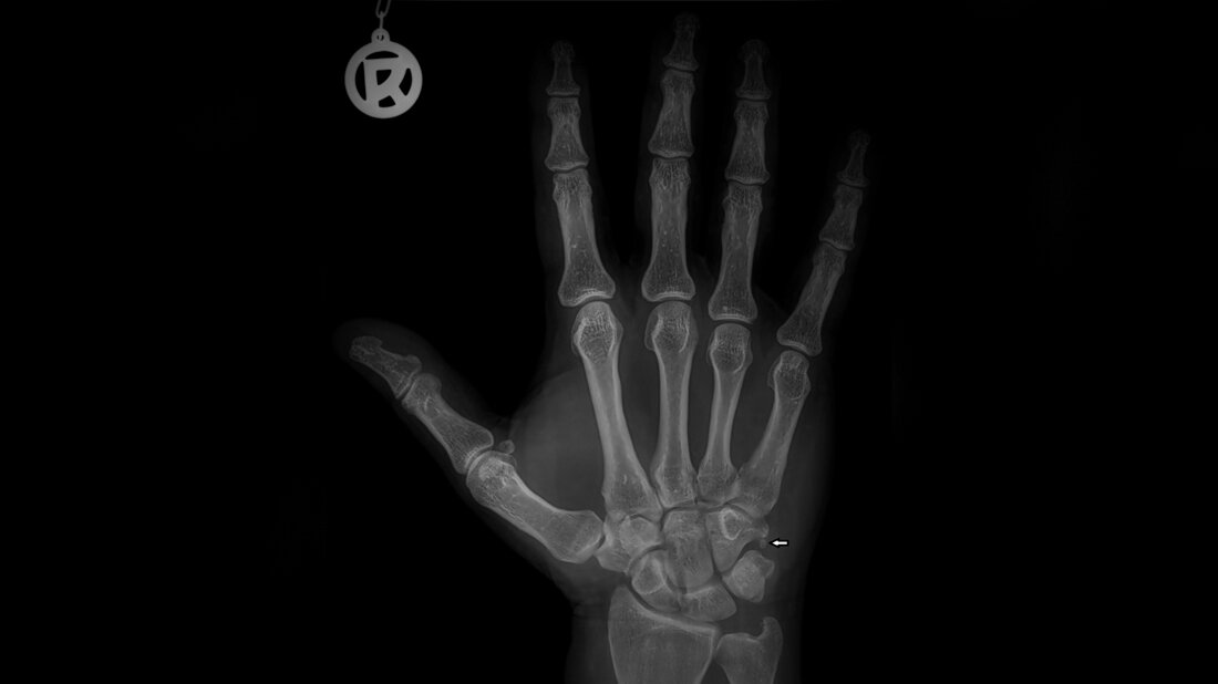 Anomalien und Normvarianten – Skelettale Veränderungen 3.26 Titelbild zum Fachbeitrag zur Bildgebung bei Akzessoria des Handgelenks – Os vesalianum manus