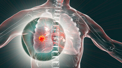 Netzwerk-Versorgung bei Lungenkrebs mit höheren Überlebsenraten