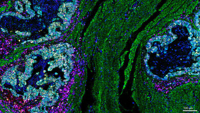 Gedächtnis-T-Zellen (rot) und Killer-T-Zellen (lila) sind gemeinsam direkt in der Nähe von Krebszellen (gelb). 