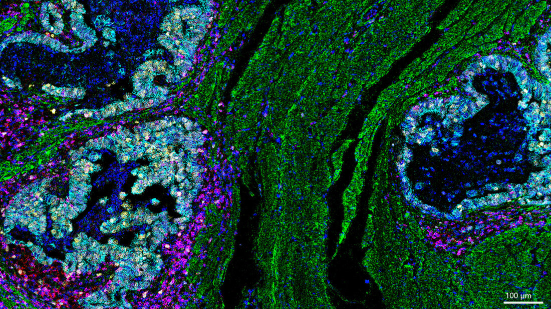 Gedächtnis-T-Zellen (rot) und Killer-T-Zellen (lila) sind gemeinsam direkt in der Nähe von Krebszellen (gelb). 