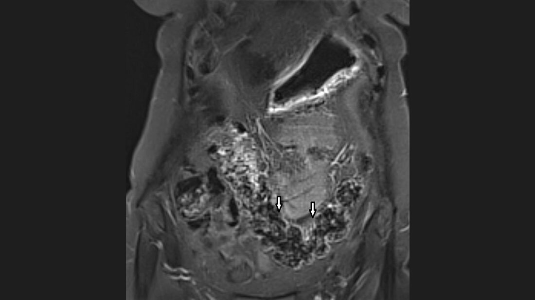 Anomalien und Normvarianten – Interne Veränderungen 2.17: Colon elongatum Titelbild des Fachbeitrags zur Bildgebung beim Colon elongatum