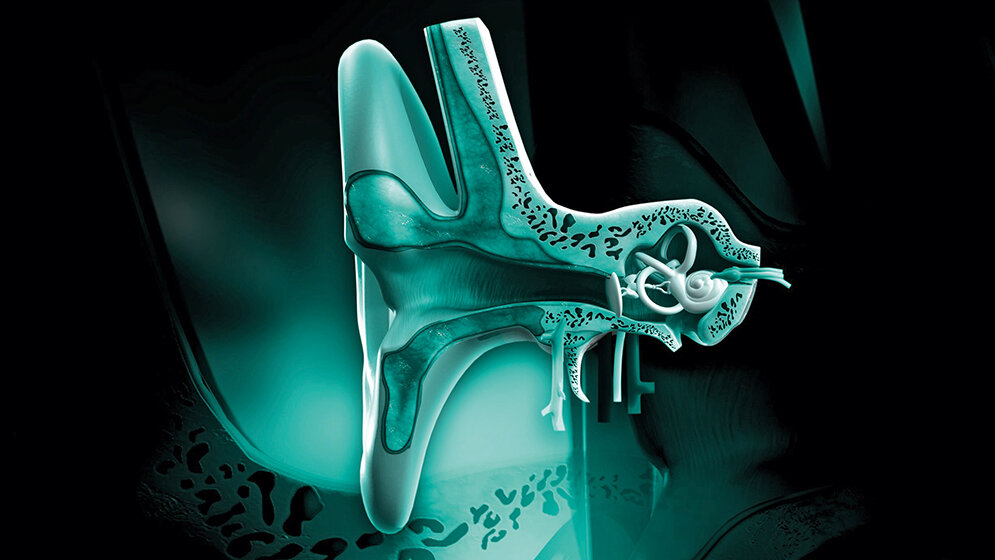 Audiologie Versorgung einer Taubheit mit einem Cochlea-Implantat