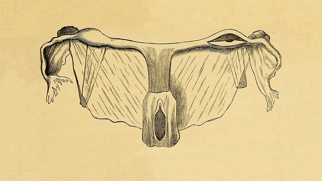 Anomalien und Normvarianten –
Interne Veränderungen 2.31:
MRKH-Syndrom Historische Zeichnung der weiblichen Geschlechtsorgane. Illustration aus: Hewitt G: Diagnose, Pathologie und Therapie der Frauen-Krankheiten