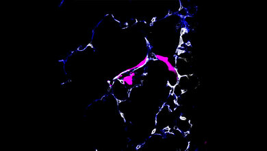 Metastasierende Krebszelle (pink) beim Verlassen eines Blutgefäßes (Lunge) 